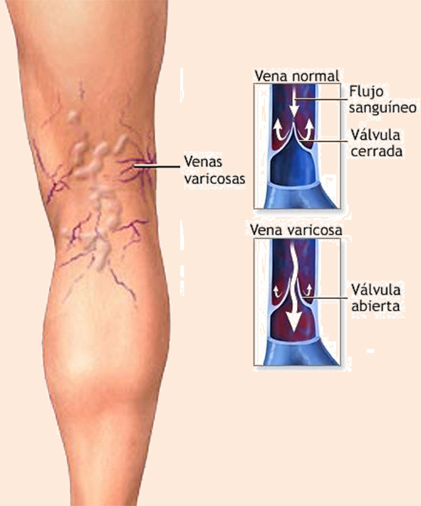 Várices - Atención Vascular : Tratamiento de Várices, Ulceras, Pie